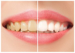 Les 3 plus grands mythes sur le blanchiment des dents à Vaud